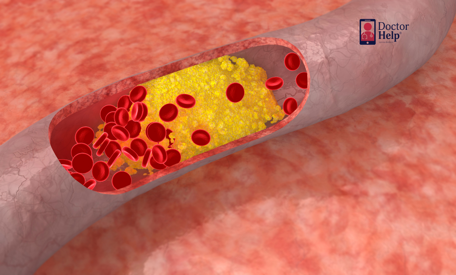 High Cholesterol