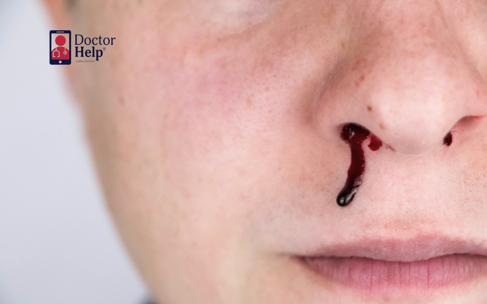 Episodes of nosebleeds