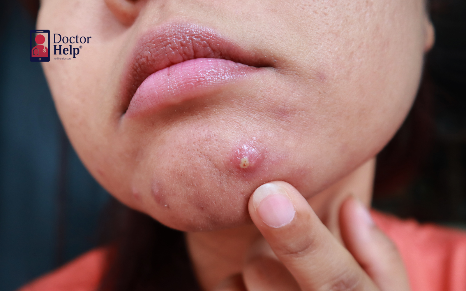 Acne & cystic acne