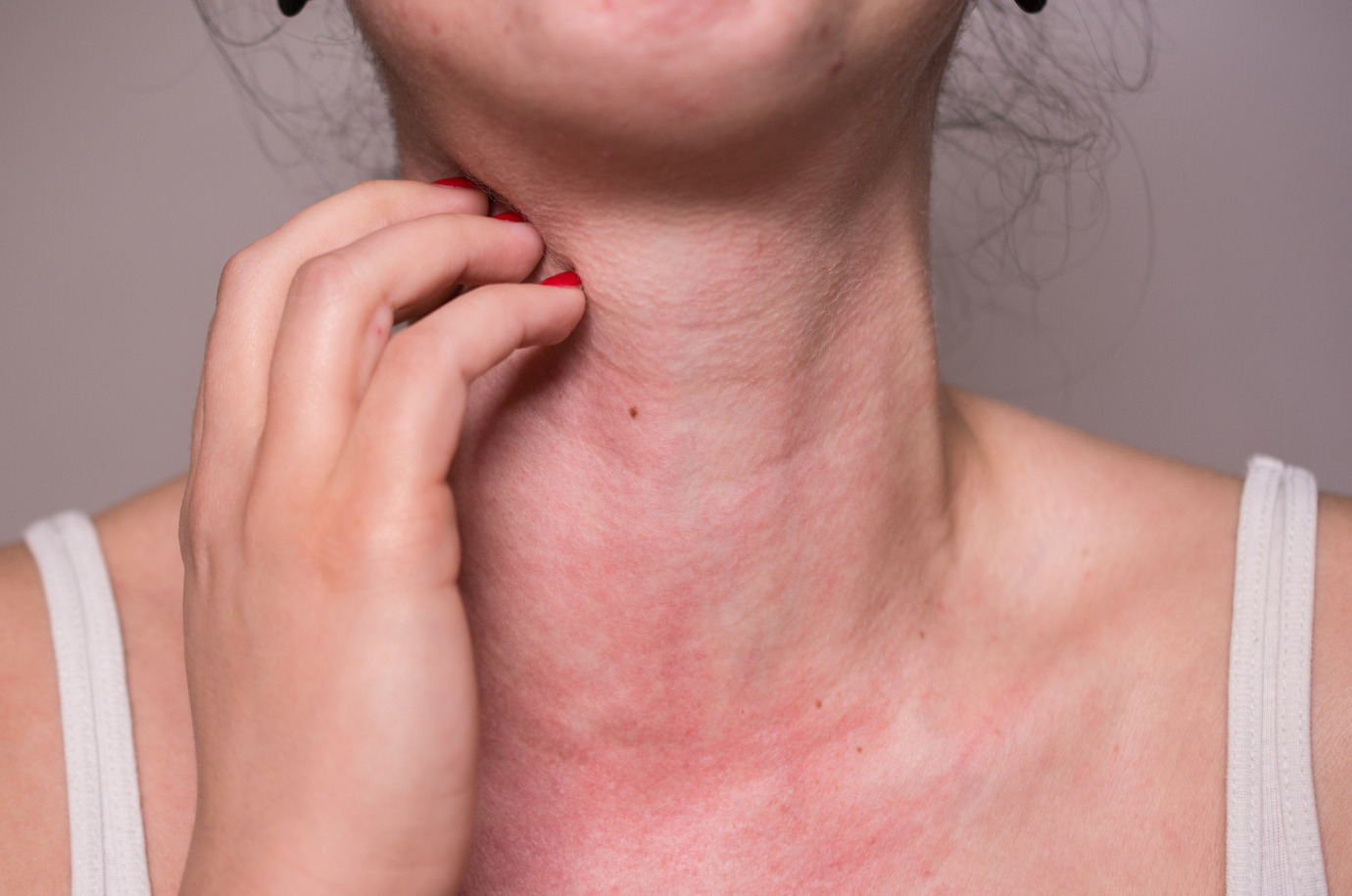 Allergies Treatment